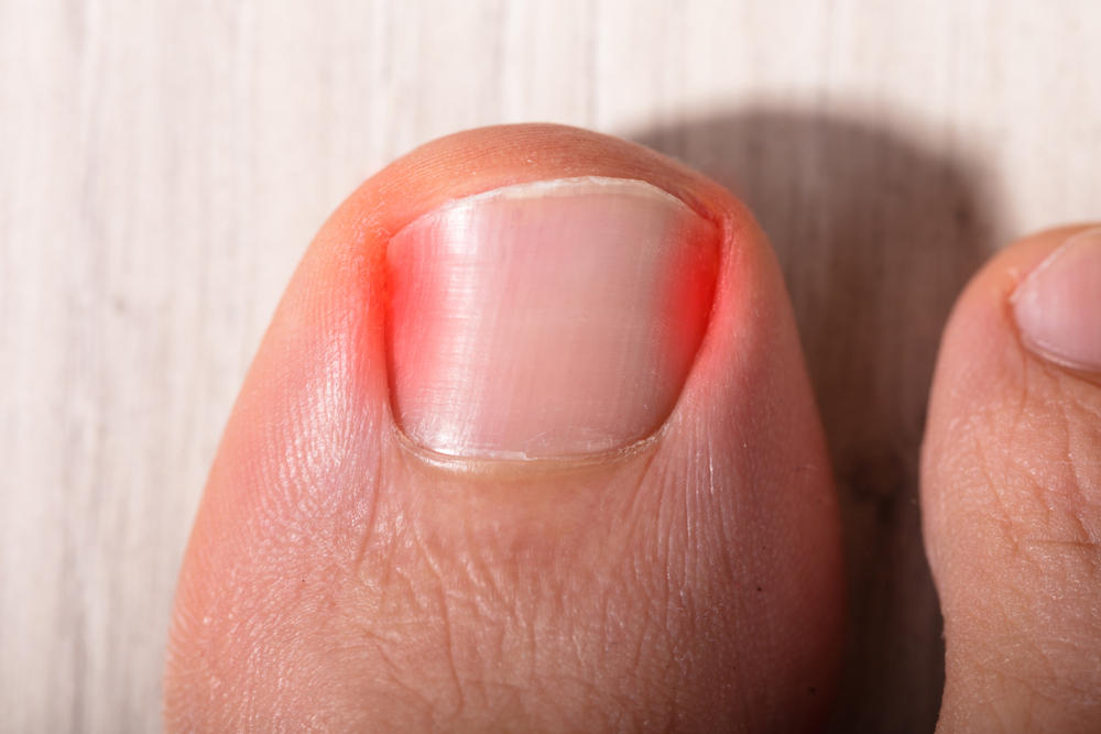 ingrown toenail 2