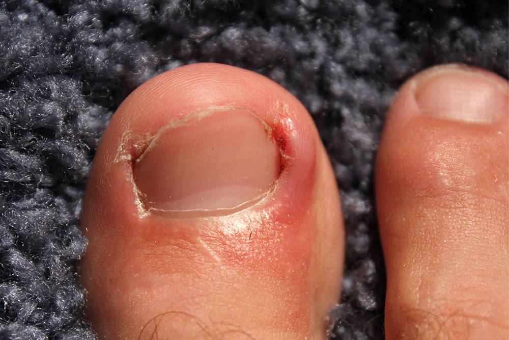 ingrown toenail