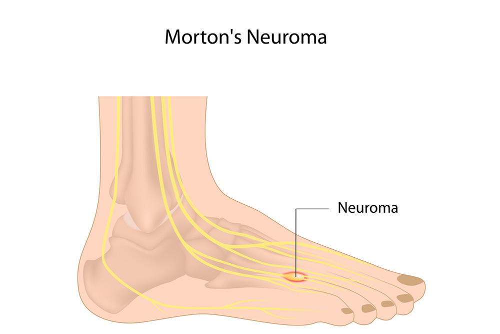 mortons neuroma