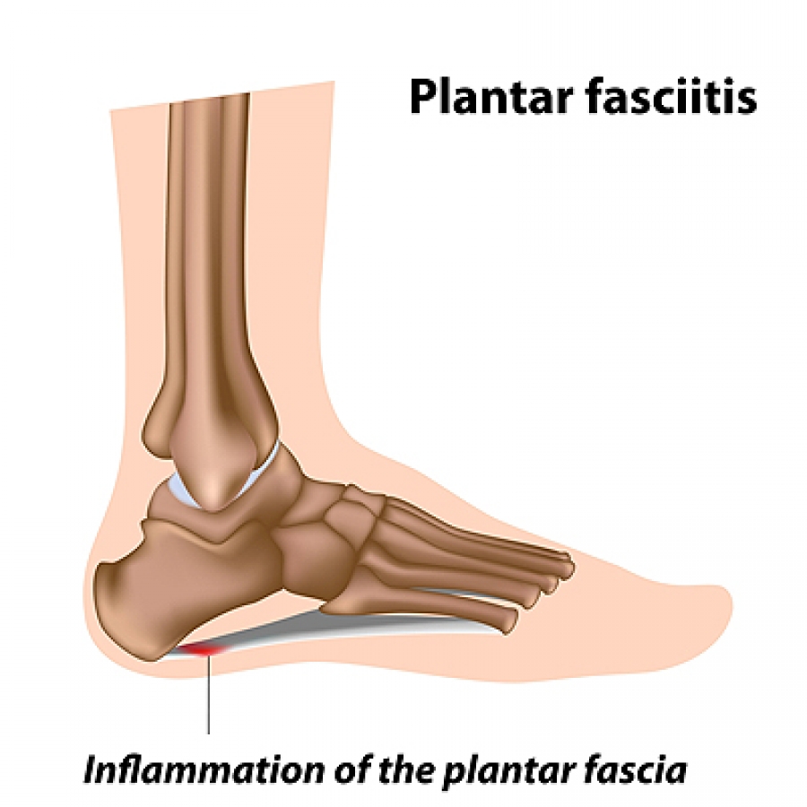 Swollen arch on sale of foot